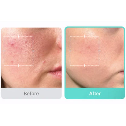 Ácido Azelaico 16% Medicube 30ML