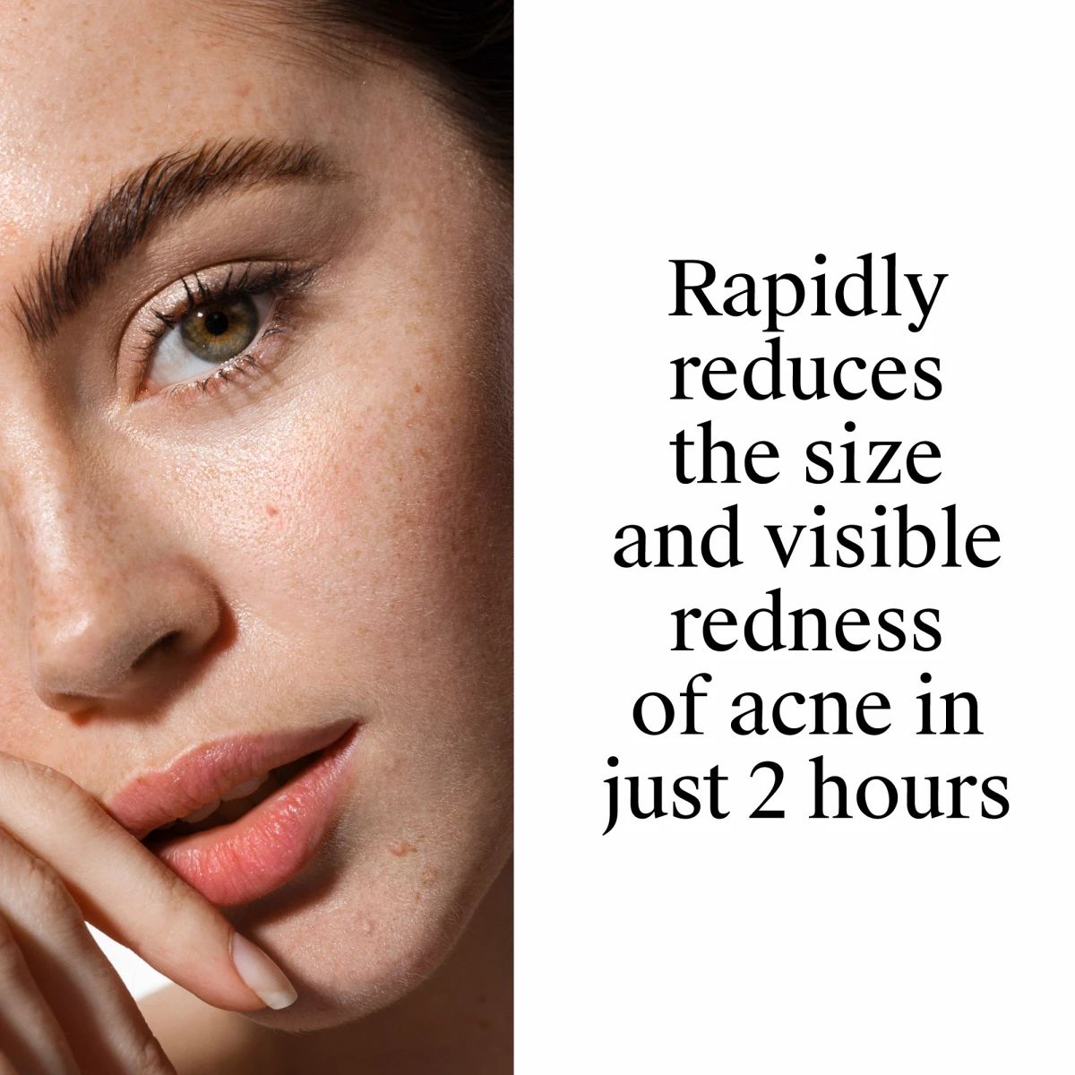 Rapid Clear Stubborn Acne Neutrogena 28gr